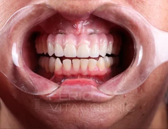 All-on-6 Dental Implants