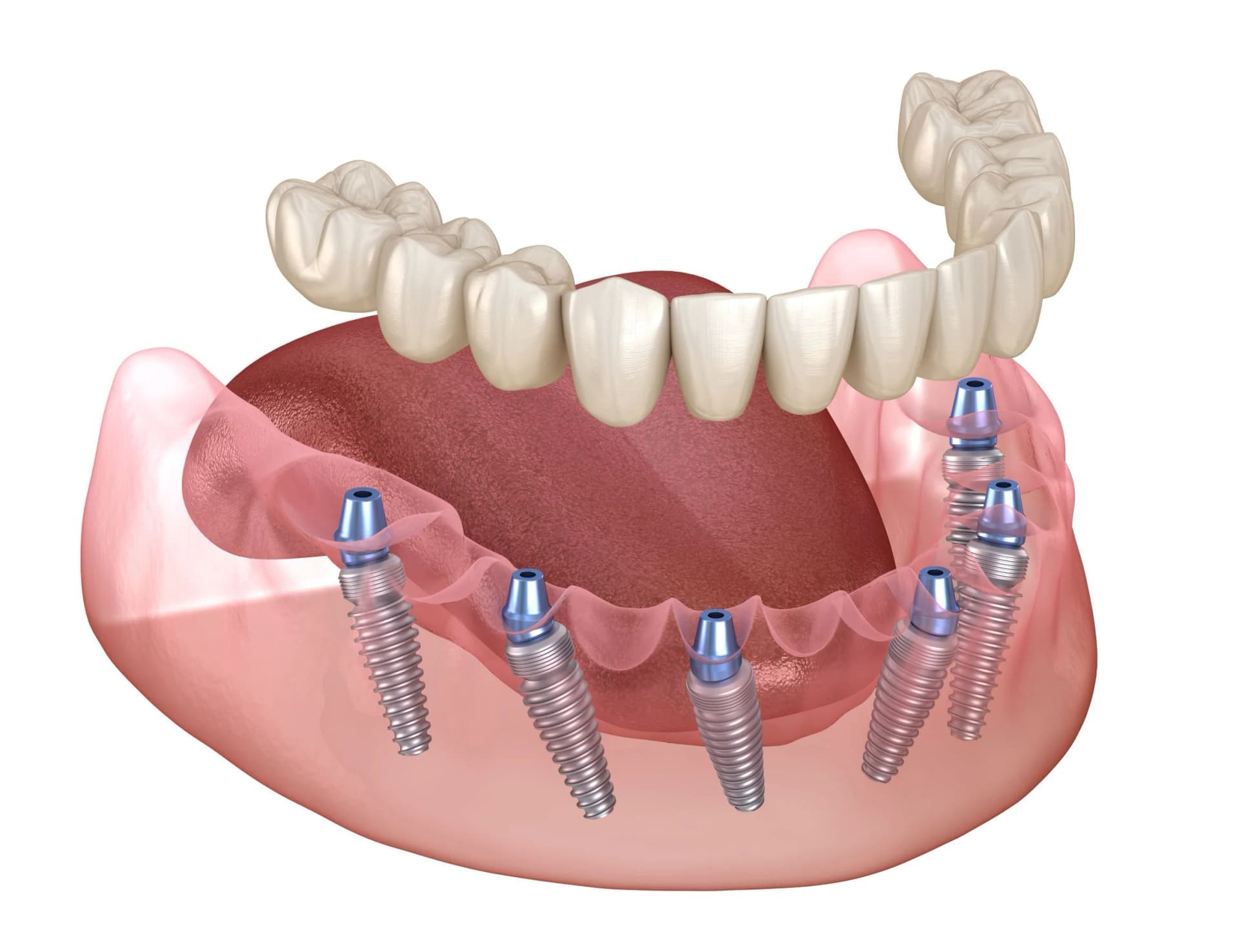 All-on-X Dental Implants