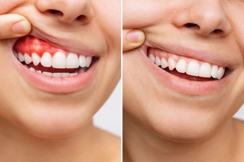 Gingivectomy / Gingivoplasty