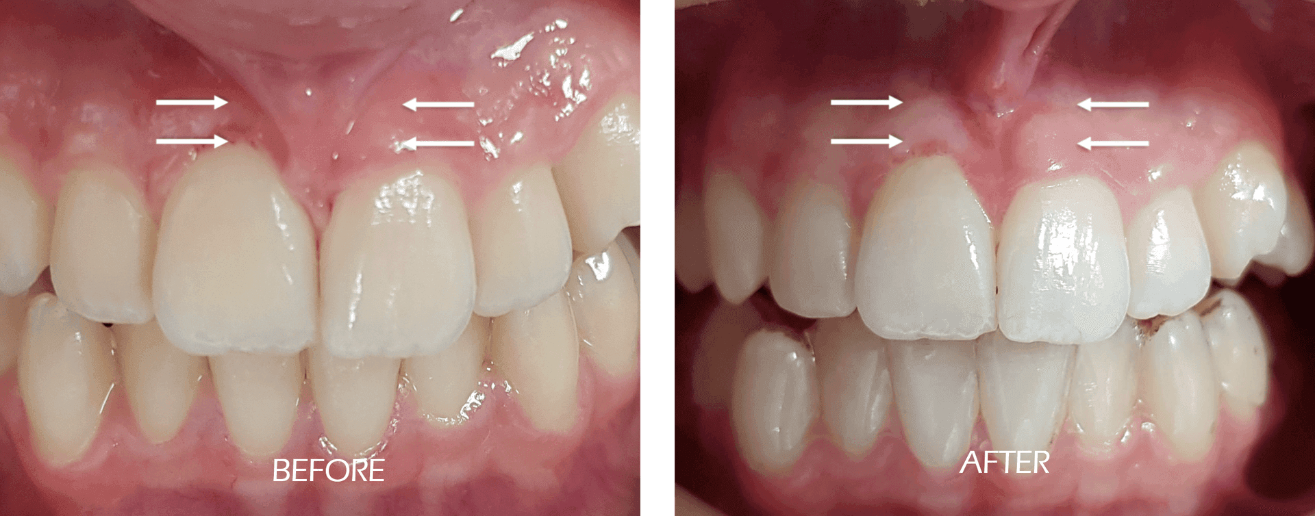 Frenectomy