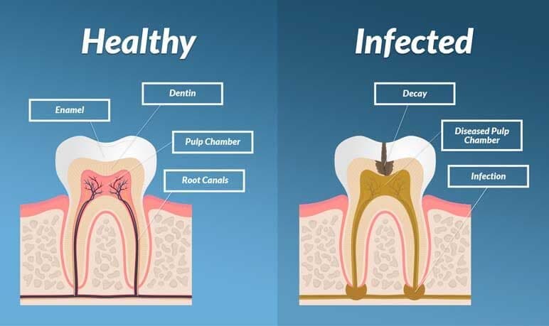 Root Canal Treatment