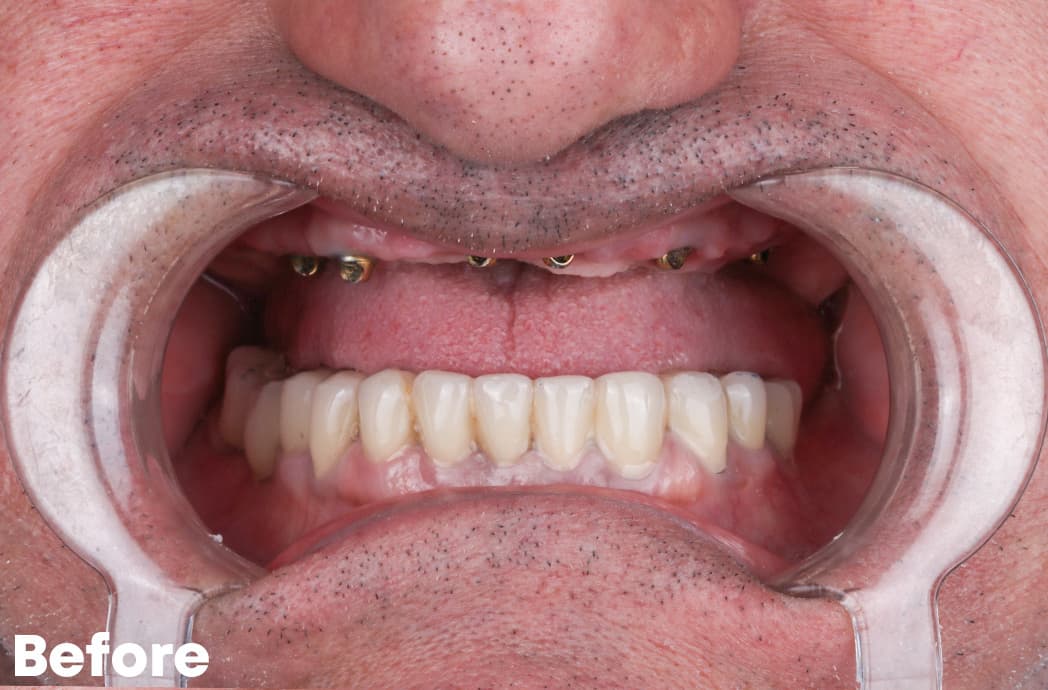 Before — All-on-4 Upper Arch