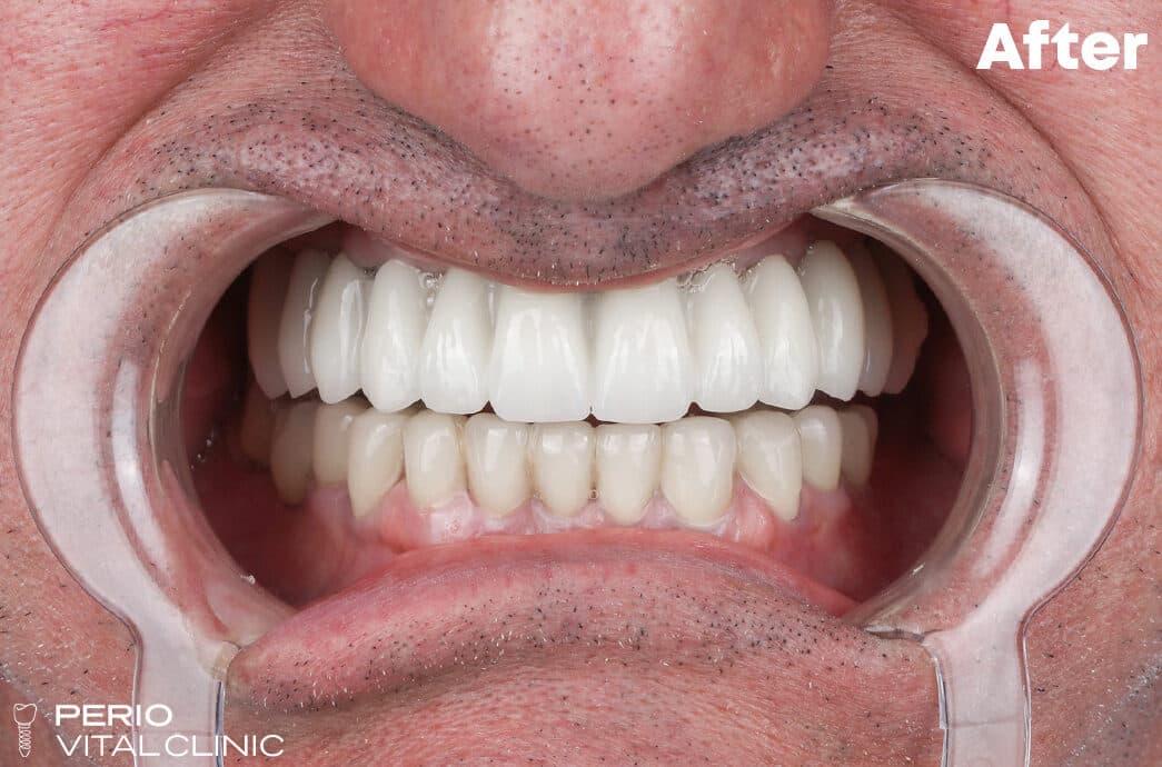 After — All-on-4 Upper Arch