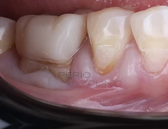 Before — Gum Grafting