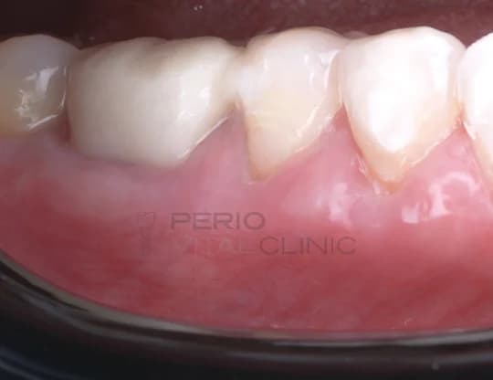 After — Gum Grafting