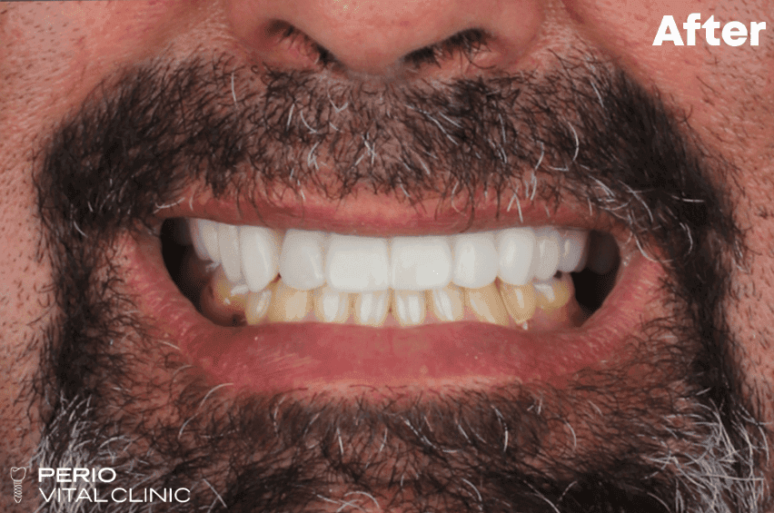 After — All-on-4 Upper Arch