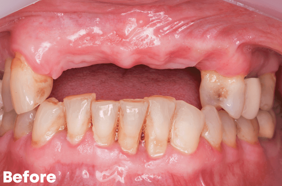 Before — All-on-6 Upper Arch