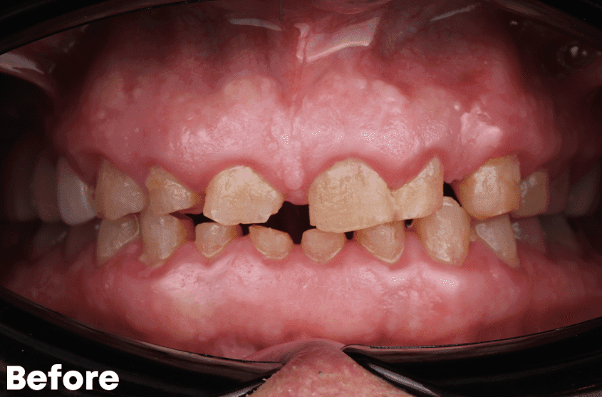 Before — All-on-4 Upper Arch