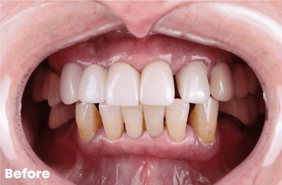 Before — All-on-6 Upper Arch