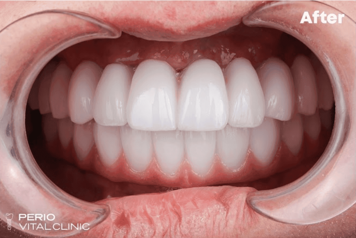 After — All-on-6 Upper Arch